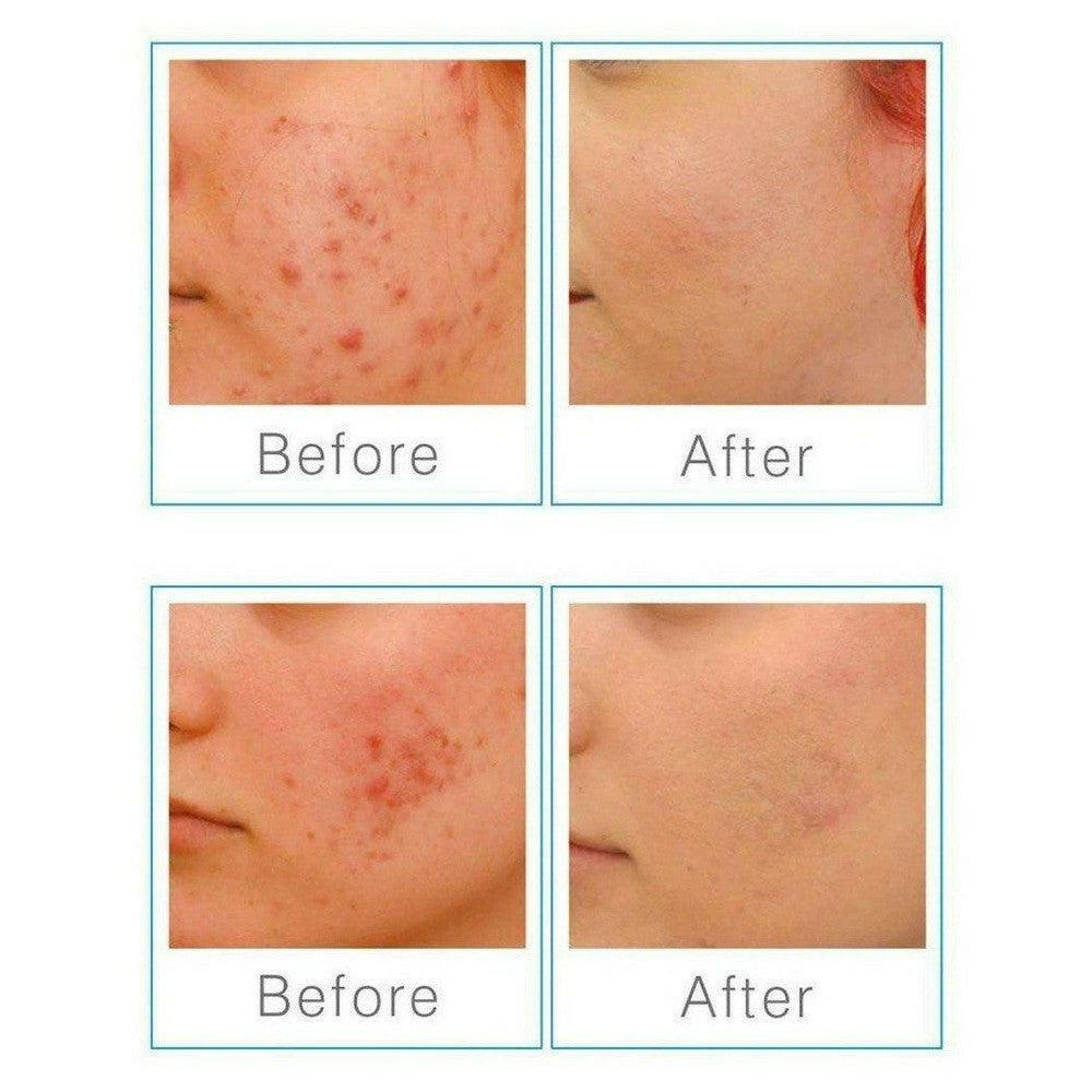 Before-after resultaten van blauw licht therapie voor rood geïrriteerde huid