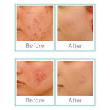 Before-after resultaten van blauw licht therapie voor rood geïrriteerde huid
