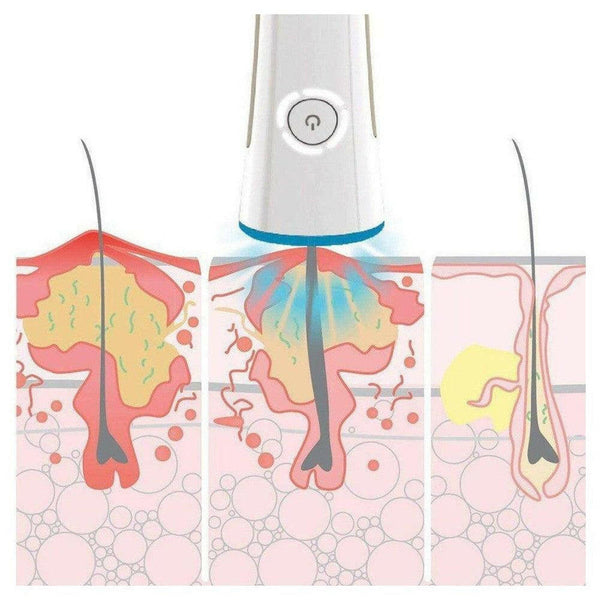 Rio Skin Revive Lite Q-acne - RIO-QACNE-Shopvoorgezondheid