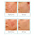 Rio Skin Revive Lite Q-acne - RIO-QACNE-Shopvoorgezondheid